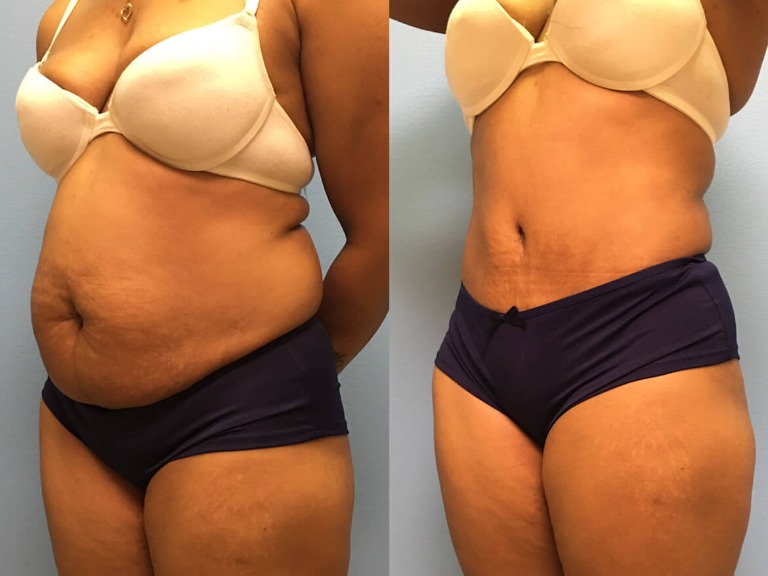 Tummy Tuck Before & After 
