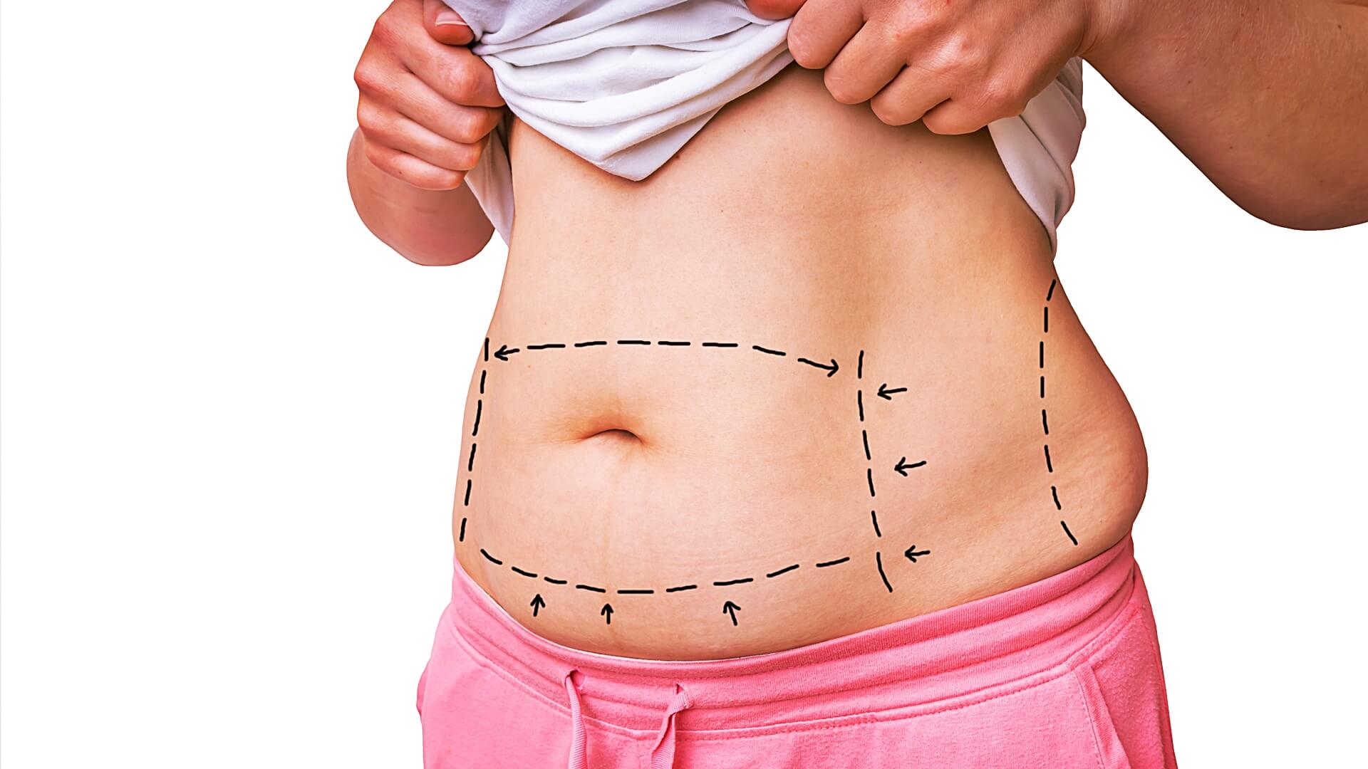 Liposuction versus liposculpture: what's the difference