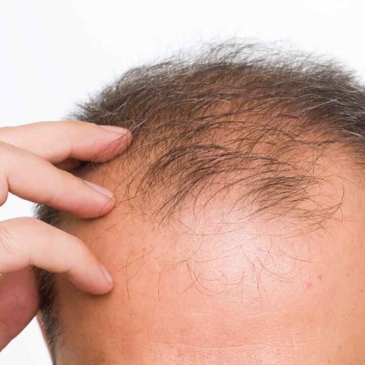 About Hair Transplant