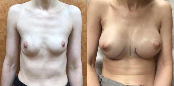 breast-before-and-after-skinsational-june2018
