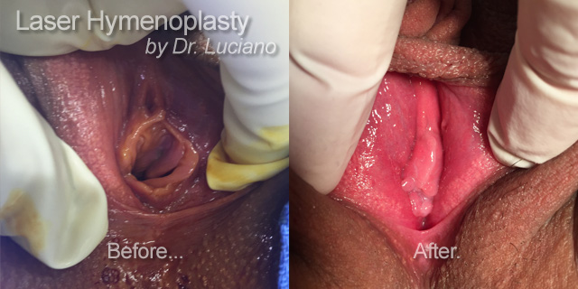 laser-hymenoplasty-by-Dr-Luciano-and-Skinsational-2
