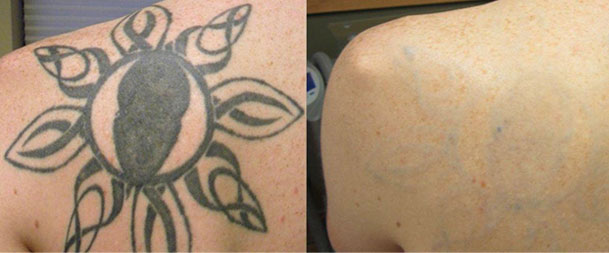 Laser Tattoo Removal in Boston, MA & Providence, RI - Skinsational