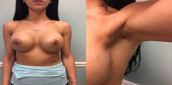 Breast After & Tiny armpit scars