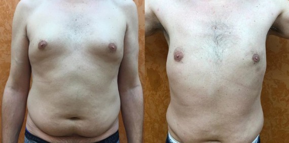 Gynecomastia Before & After