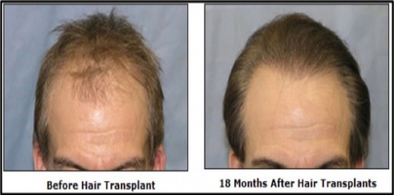 Hair transplant