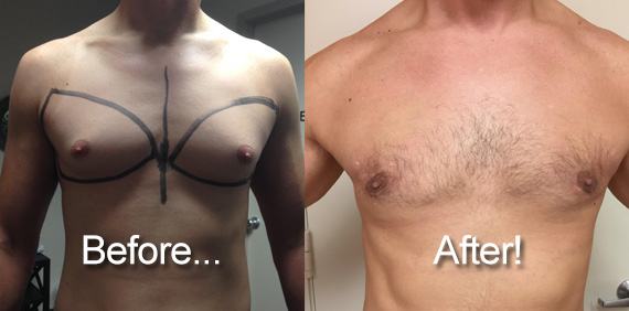 Gynecomastia by Dr. Luciano